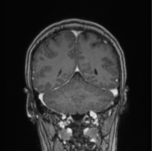 File:Cerebral abscess from pulmonary arteriovenous malformation (Radiopaedia 86275-102291 L 29).png