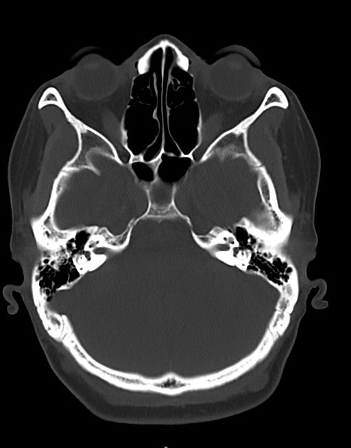 Cerebral abscesses (Radiopaedia 70458-80568 Axial bone window 18).jpg