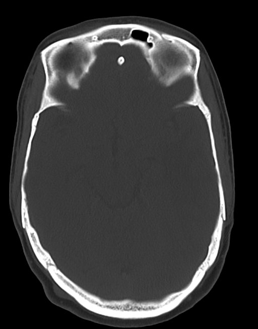 Cerebral abscesses (Radiopaedia 70458-80568 Axial bone window 26).jpg