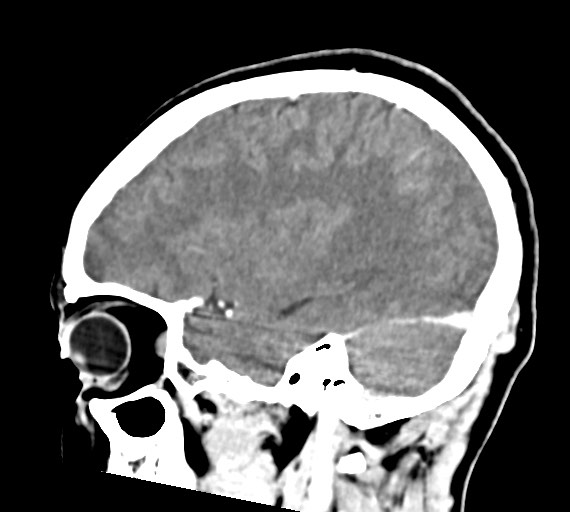 File:Cerebral abscesses (Radiopaedia 70458-80568 Sagittal Contrast 40).jpg