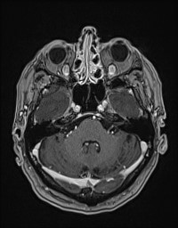 Cerebral amyloid angiopathy-related inflammation (Radiopaedia 58270-65377 Axial T1 C+ fat sat 30).jpg