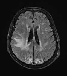 File:Cerebral amyloid angiopathy-related inflammation (Radiopaedia 74836-85849 Axial FLAIR 19).jpg