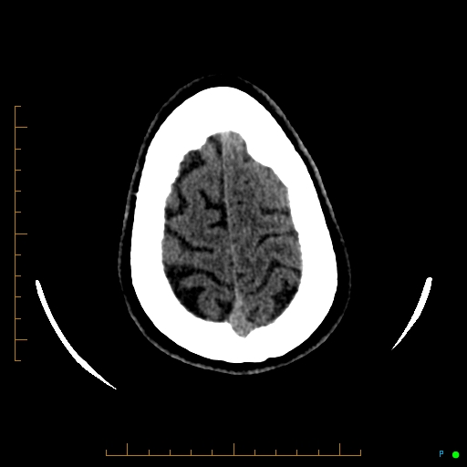 Cerebral arteriovenous malformation (AVM) (Radiopaedia 78162-90706 Axial non-contrast 57).jpg