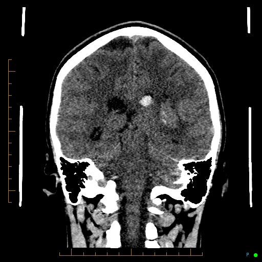 Cerebral arteriovenous malformation (AVM) (Radiopaedia 78162-90706 Coronal non-contrast 62).jpg