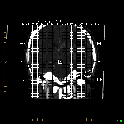 Cerebral arteriovenous malformation (AVM) (Radiopaedia 78162-90706 Sagittal CTA 1).jpg