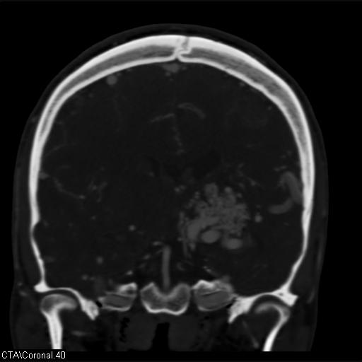 Cerebral arteriovenous malformation (Radiopaedia 28518-28759 C 40).jpg