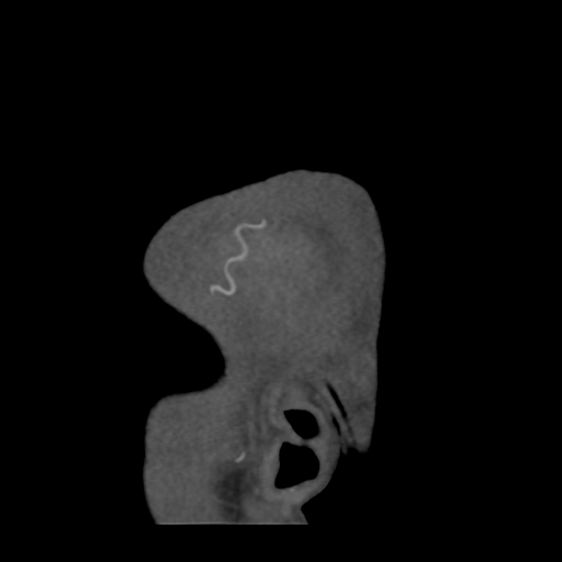 Cerebral arteriovenous malformation (Radiopaedia 39259-41505 Sagittal 2).png