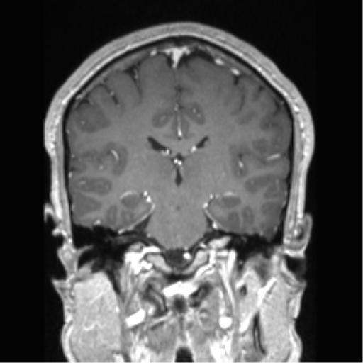 Cerebral arteriovenous malformation (Radiopaedia 39259-41506 Coronal T1 C+ 44).png