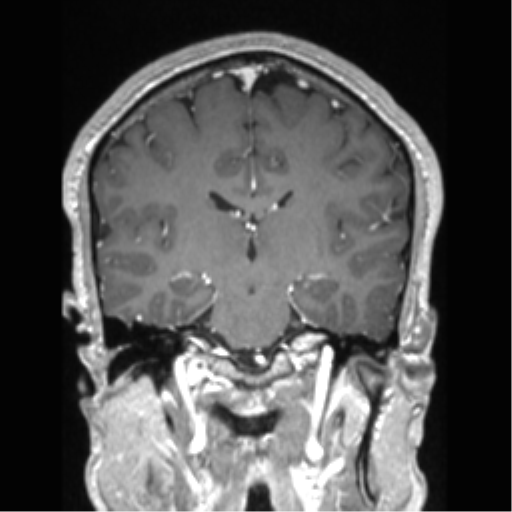 Cerebral arteriovenous malformation (Radiopaedia 39259-41506 Coronal T1 C+ 45).png