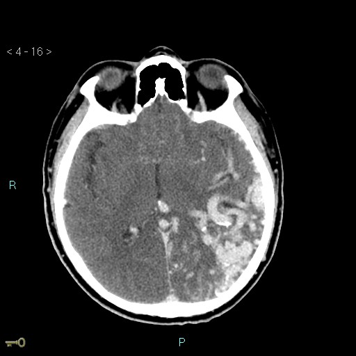 File:Cerebral arteriovenous malformation (Radiopaedia 40528-43125 Axial C+ delayed 16).jpg