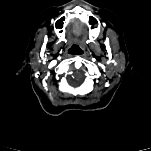 Cerebral arteriovenous malformation (Radiopaedia 73830-84645 Axial C+ delayed 90).jpg