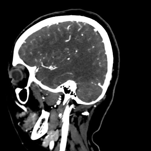 Cerebral arteriovenous malformation (Radiopaedia 73830-84645 Sagittal C+ delayed 70).jpg