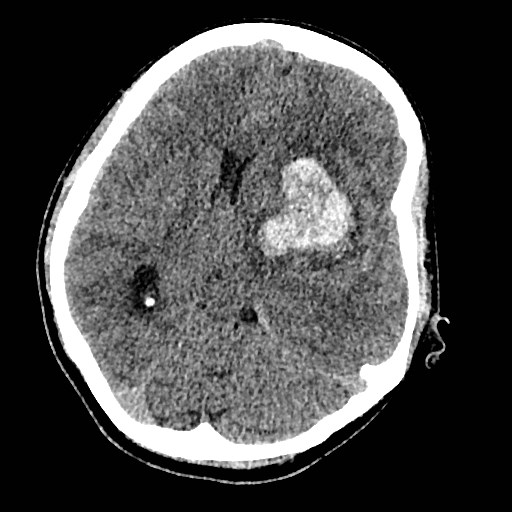 Cerebral arteriovenous malformation (Radiopaedia 79677-92887 Axial non-contrast 17).jpg