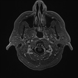 File:Cerebral arteriovenous malformation (Radiopaedia 84015-99245 Axial T1 C+ 11).jpg