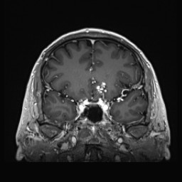 Cerebral arteriovenous malformation (Radiopaedia 84015-99245 Coronal T1 C+ 58).jpg
