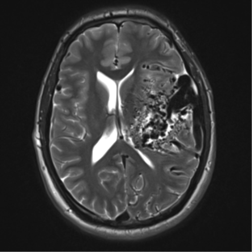 File:Cerebral arteriovenous malformation - huge (Radiopaedia 35734-37272 Axial T2 13).png