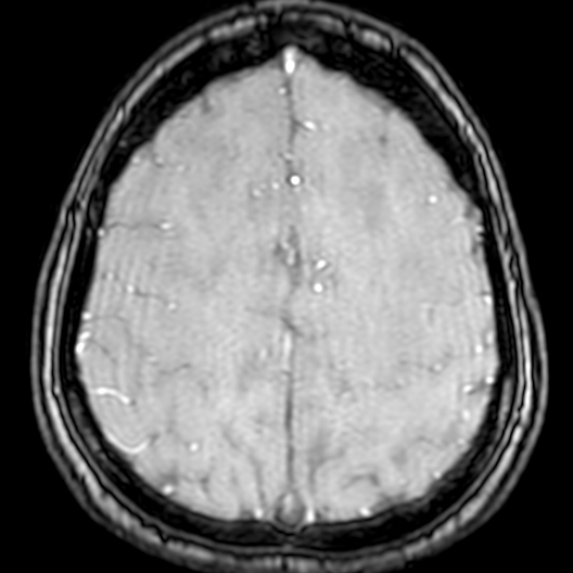 Cerebral arteriovenous malformation at posterior body of corpus callosum (Radiopaedia 74111-84925 Axial MRA 174).jpg