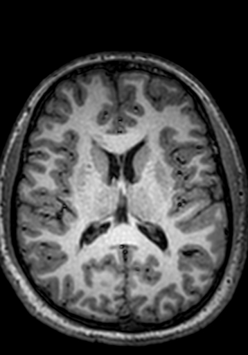 File:Cerebral arteriovenous malformation at posterior body of corpus callosum (Radiopaedia 74111-84925 Axial T1 125).jpg
