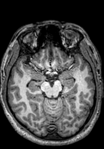 Cerebral arteriovenous malformation at posterior body of corpus callosum (Radiopaedia 74111-84925 Axial T1 190).jpg