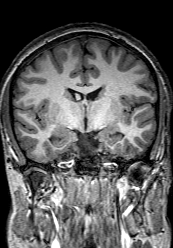Cerebral arteriovenous malformation at posterior body of corpus callosum (Radiopaedia 74111-84925 Coronal T1 152).jpg