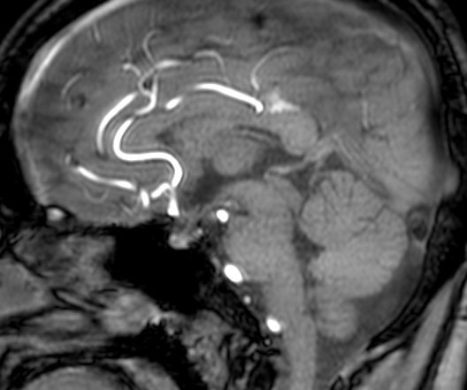 File:Cerebral arteriovenous malformation at posterior body of corpus callosum (Radiopaedia 74111-84925 J 197).jpg
