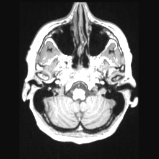 Cerebral arteriovenous malformation with hemorrhage (Radiopaedia 34422-35737 Axial T1 14).png
