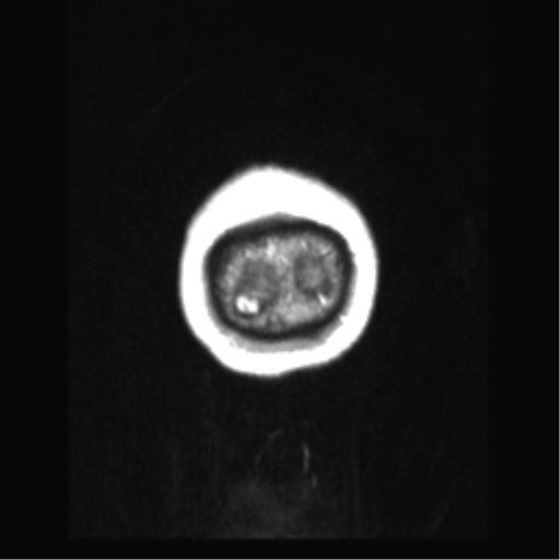 Cerebral arteriovenous malformation with hemorrhage (Radiopaedia 34422-35737 Coronal T1 C+ 3).png