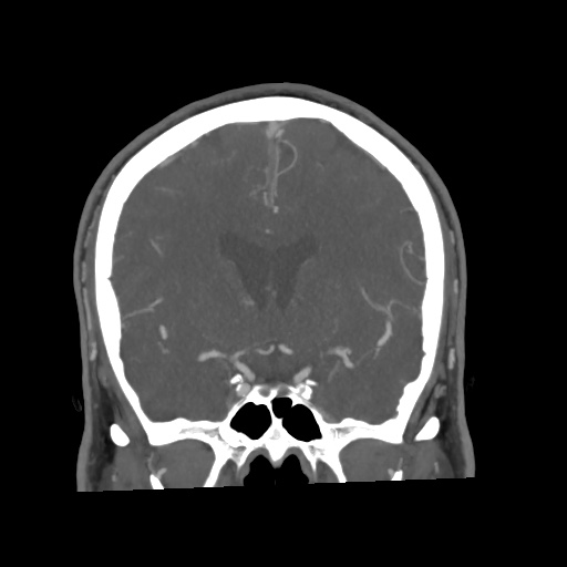 Cerebral arteriovenous malformation with lobar hemorrhage (Radiopaedia 35598-57216 C 40).jpg
