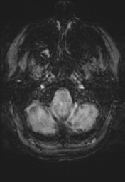 File:Cerebral cavernoma and development venous anomaly (Radiopaedia 37603-39482 Axial SWI 5).png