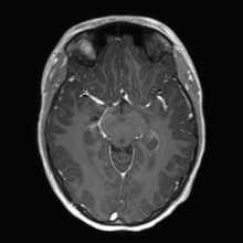 File:Cerebral cavernous venous malformation (Radiopaedia 70008-80021 Axial T1 C+ 30).jpg