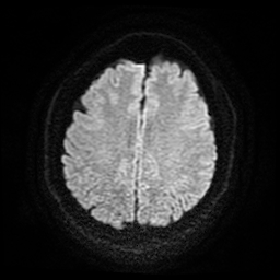 Cerebral cavernous venous malformation (Zabramski type II) (Radiopaedia 85511-101198 Axial DWI 55).jpg