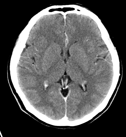 File:Cerebral cavernous venous malformations (Radiopaedia 48117-52945 Axial C+ delayed 18).png