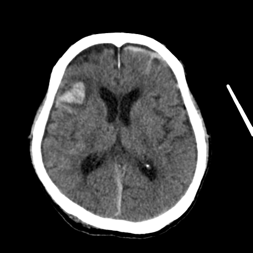 File:Cerebral contusions, subarachnoid hemorrhage and subdural hygromas (Radiopaedia 55399-61827 Axial non-contrast 19).png