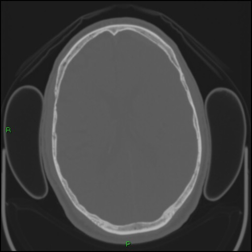 Cerebral contusions (Radiopaedia 33868-35039 Axial bone window 125).jpg