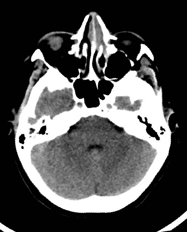 Cerebral edema due to severe hyponatremia (Radiopaedia 89826-106938 Axial non-contrast 29).jpg