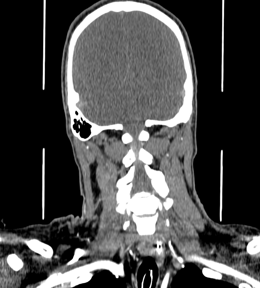 Cerebral edema in an overdose patient (Radiopaedia 72005-82539 B 126).jpg