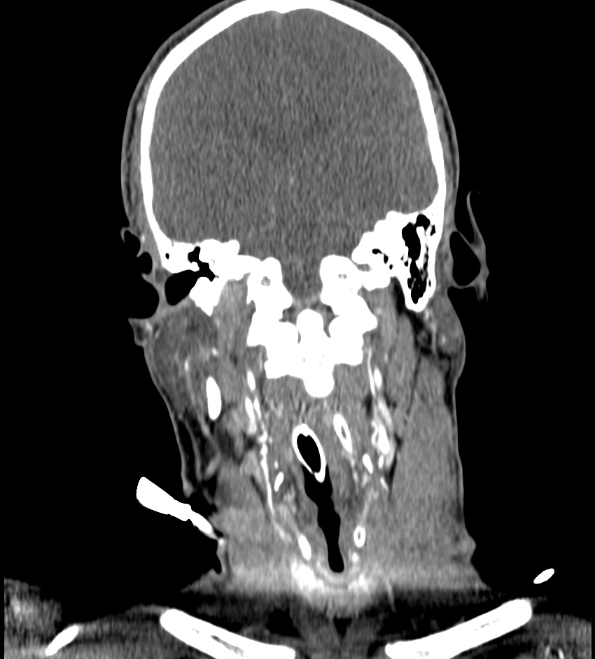 Cerebral edema in an overdose patient (Radiopaedia 72005-82539 B 74).jpg