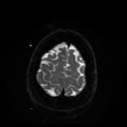 Cerebral embolic infarcts (embolic shower) (Radiopaedia 49837-55108 Axial DWI 6).jpg