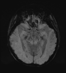 Cerebral embolic infarcts (embolic shower) (Radiopaedia 72391-82921 Axial SWI 29).jpg