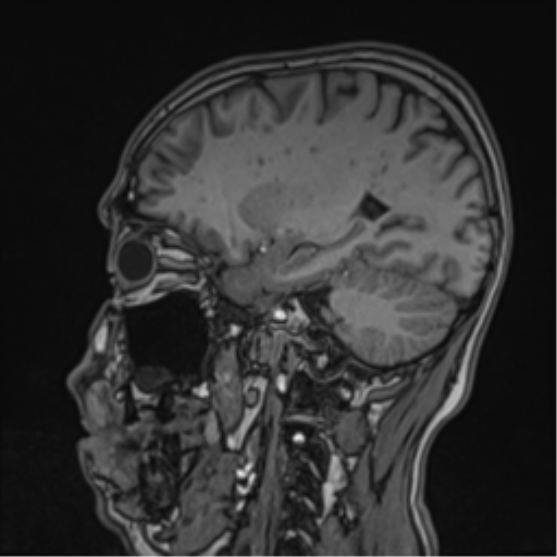 Cerebral fat embolism (Radiopaedia 57697-64639 Sagittal T1 21).png