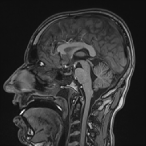 Cerebral fat embolism (Radiopaedia 57697-64639 Sagittal T1 27).png