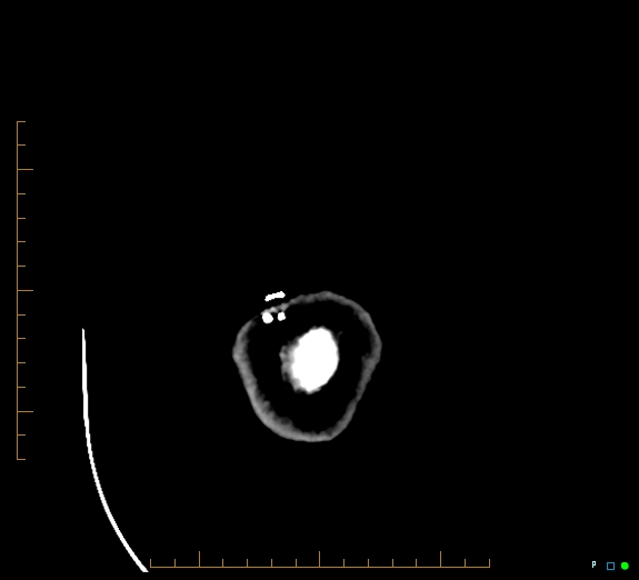 Cerebral fat embolism (Radiopaedia 85521-101220 Axial non-contrast 61).jpg