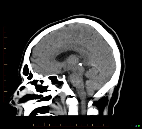 Cerebral fat embolism (Radiopaedia 85521-101220 B 29).jpg