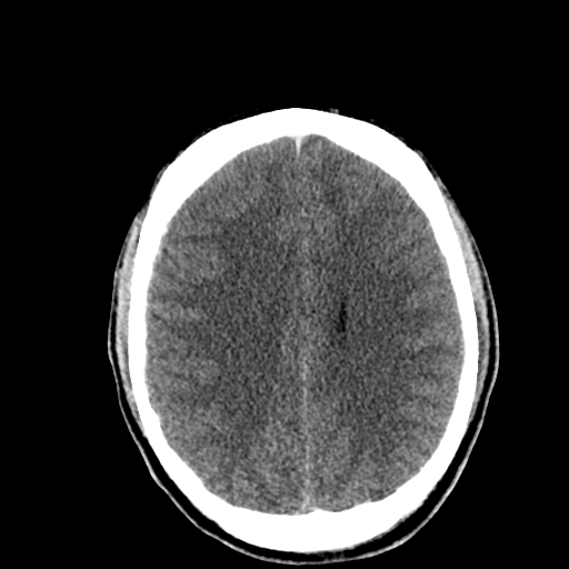 File:Cerebral hemorrhagic contusions- temporal evolution (Radiopaedia 40224-42753 Axial non-contrast 22).png