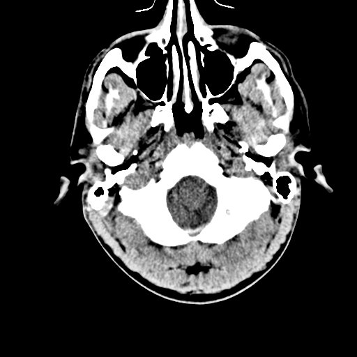 File:Cerebral hemorrhagic contusions- temporal evolution (Radiopaedia 40224-42753 Axial non-contrast 3).png
