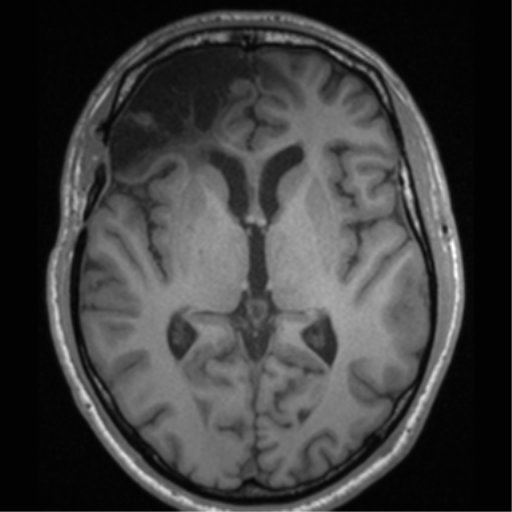 Cerebral hemorrhagic contusions- temporal evolution (Radiopaedia 40224-42757 Axial T1 38).png