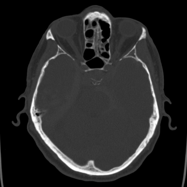 Cerebral hemorrhagic contusions (Radiopaedia 23145-23188 Axial bone window 18).jpg