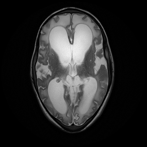 File:Cerebral manifestations of mucopolysaccharidosis type I (Radiopaedia 59171-66487 Axial T2 11).jpg