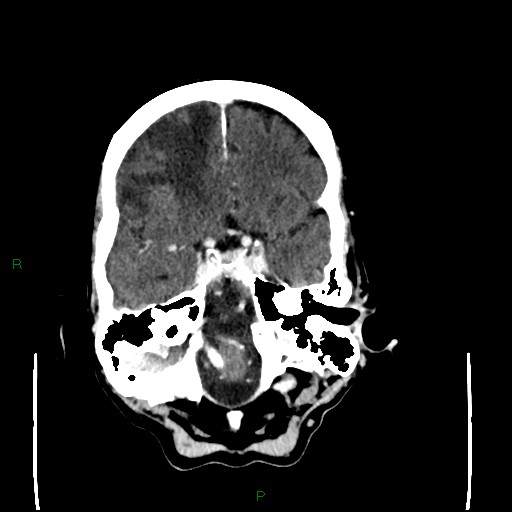 Cerebral metastases - breast primary (Radiopaedia 77653-89857 Axial C+ delayed 33).jpg