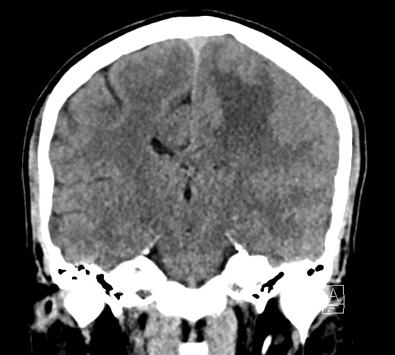 Cerebral metastases - testicular choriocarcinoma (Radiopaedia 84486-99855 Coronal C+ delayed 35).jpg